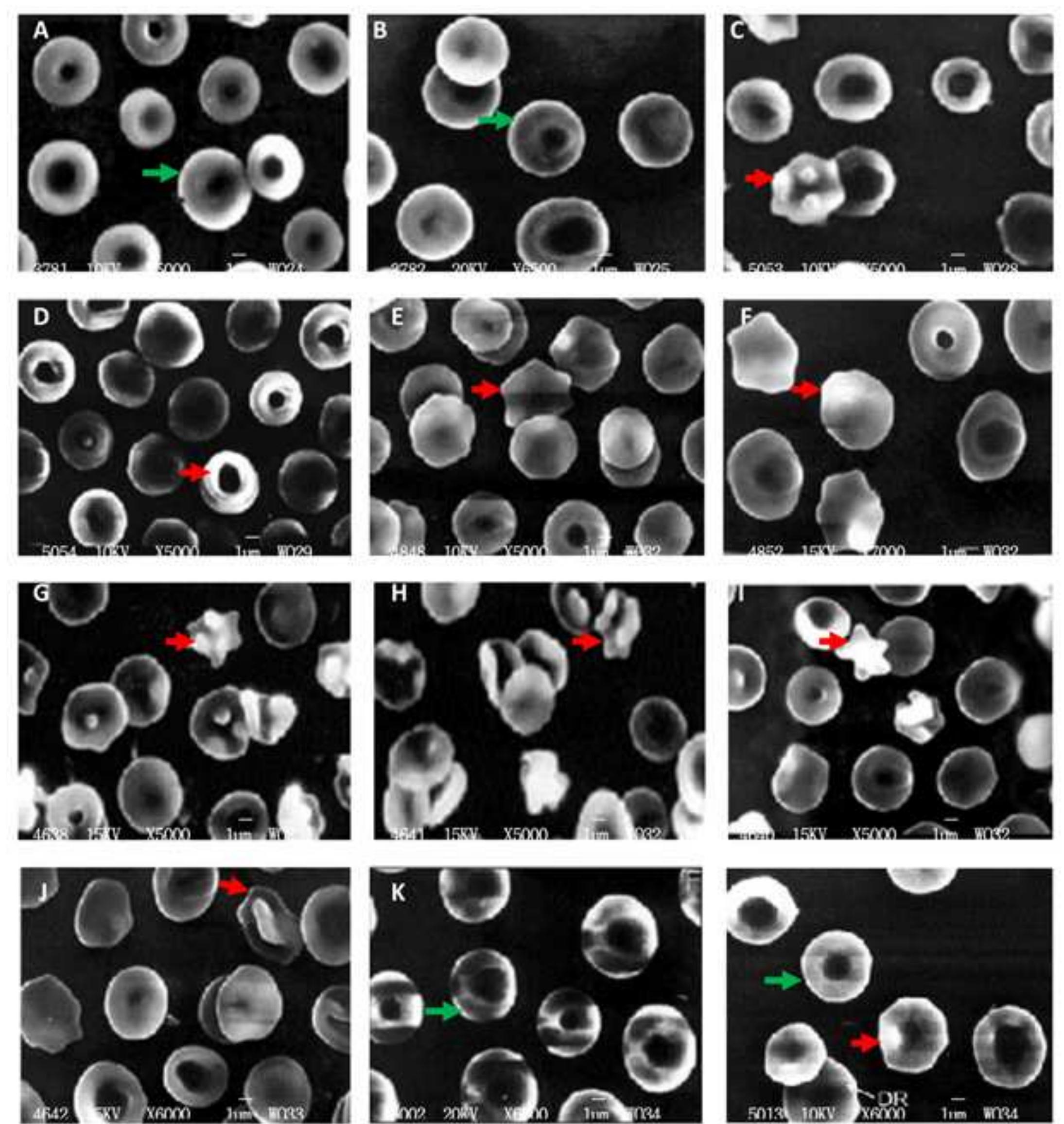 Bizzare Rbcs (PDF) Effect of Exposure of Mobile Phone Radiations on Red Blood Cell ...