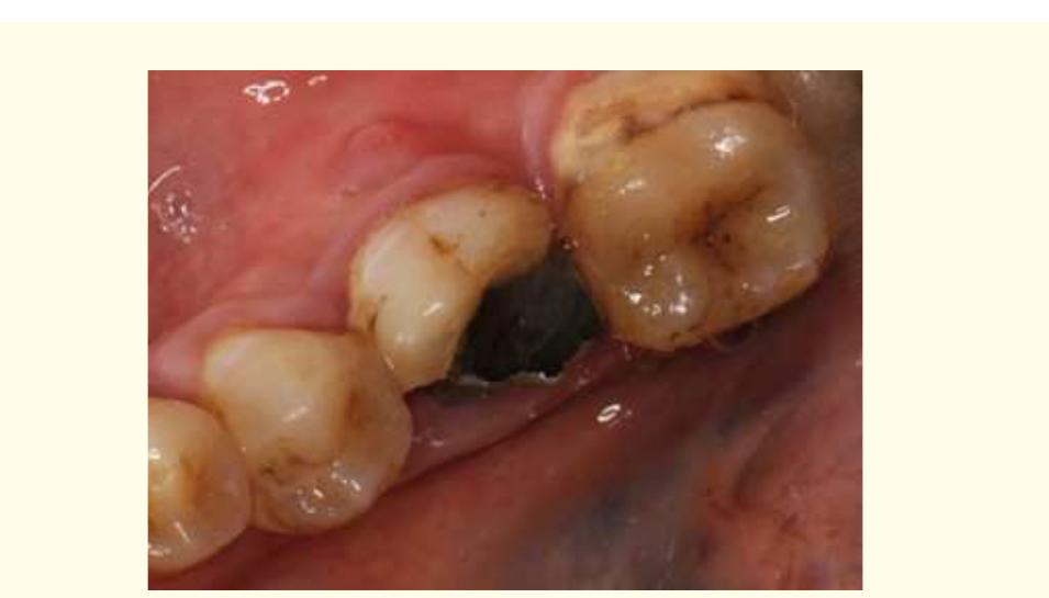 (PDF) Alveolar Ridge Preservation in Mandibular Molars Using Mixture of ...