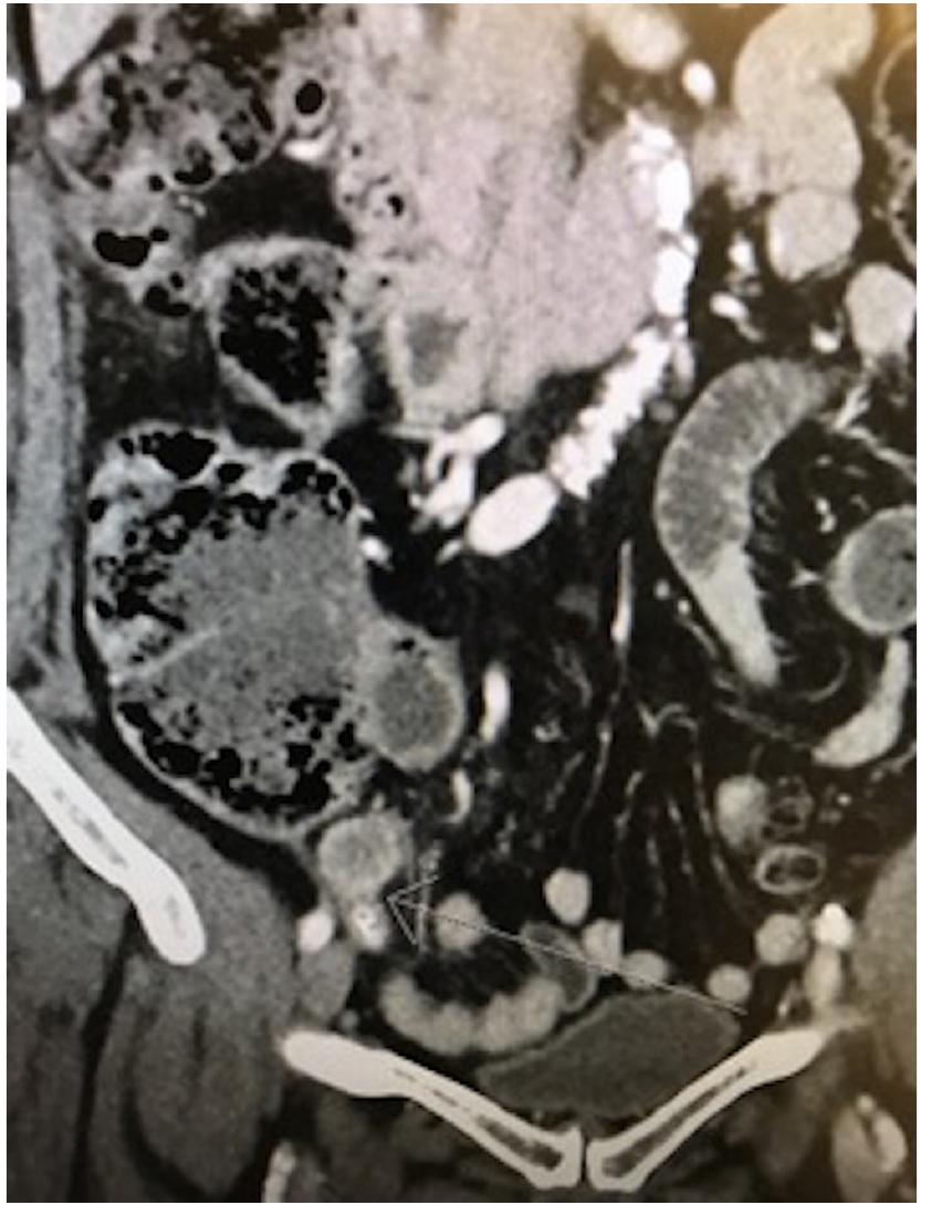 Figure 2 - from Appendiceal schwannoma: a rare cause of