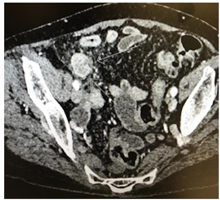 Figure 2 - from Appendiceal schwannoma: a rare cause of