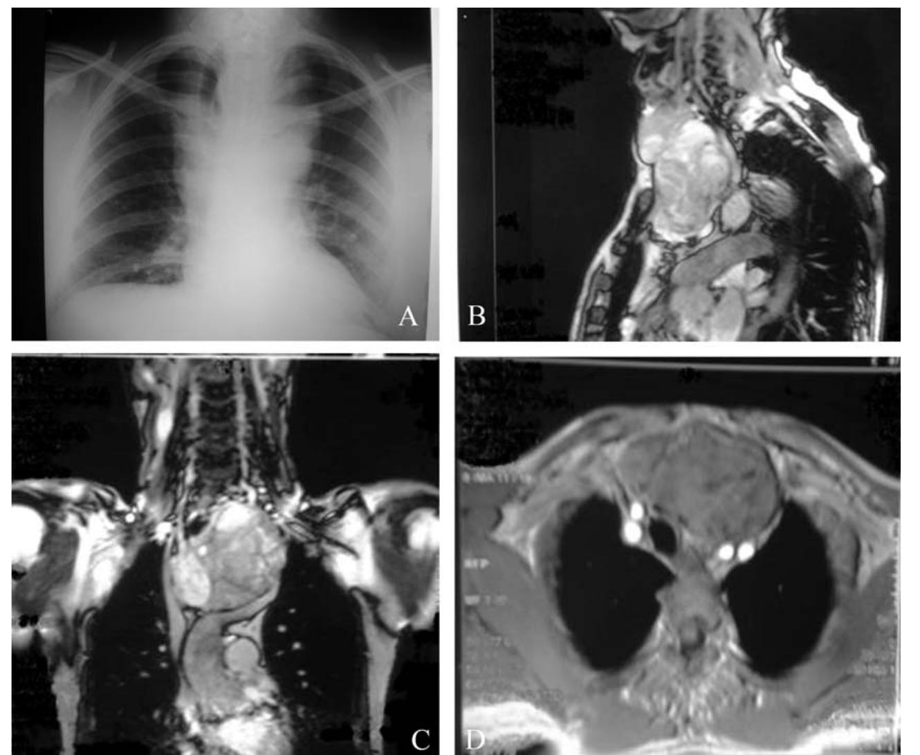 Substernal Goiter Incision (PDF) Substernal Goiter: When is a Sternotomy Required?