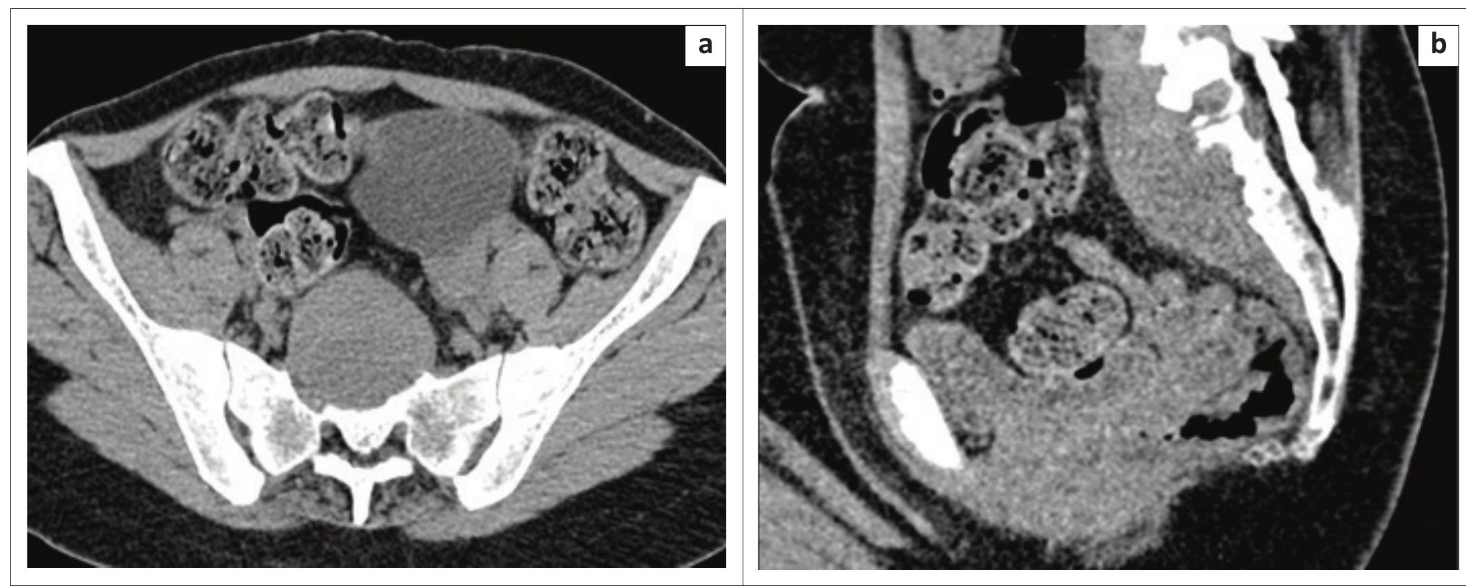 Figure 2 - from High presacral collection approached through