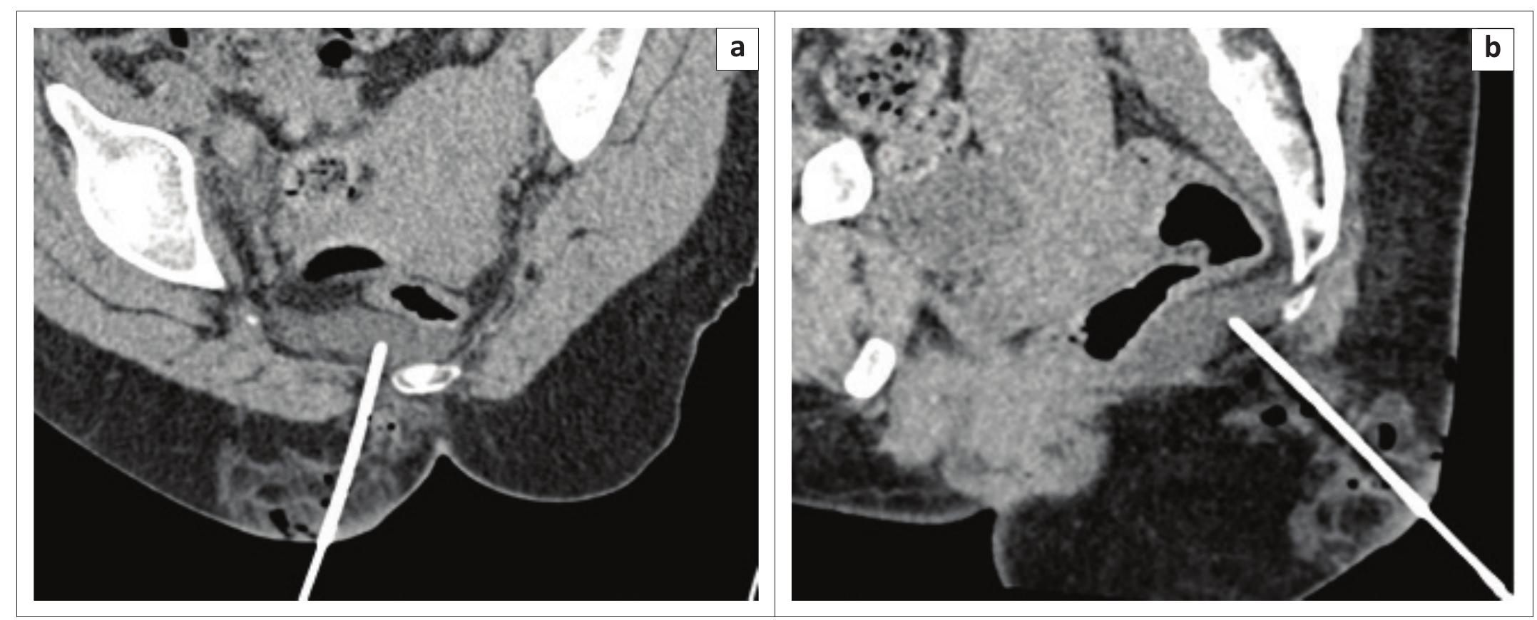 Figure 2 - from High presacral collection approached through