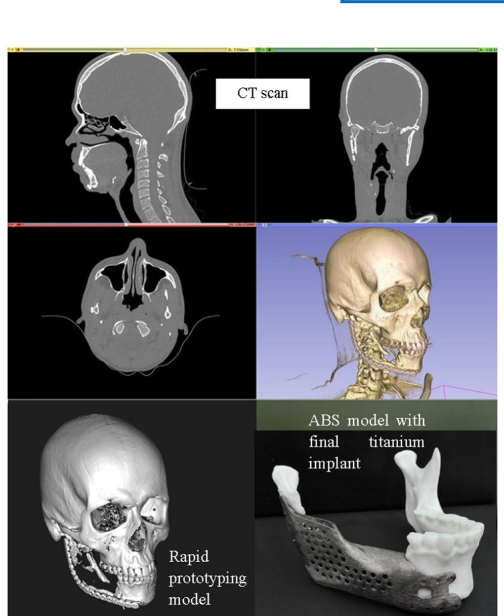 Ct Conversion Powder Example of conversion of ct into a final mandibular implant
