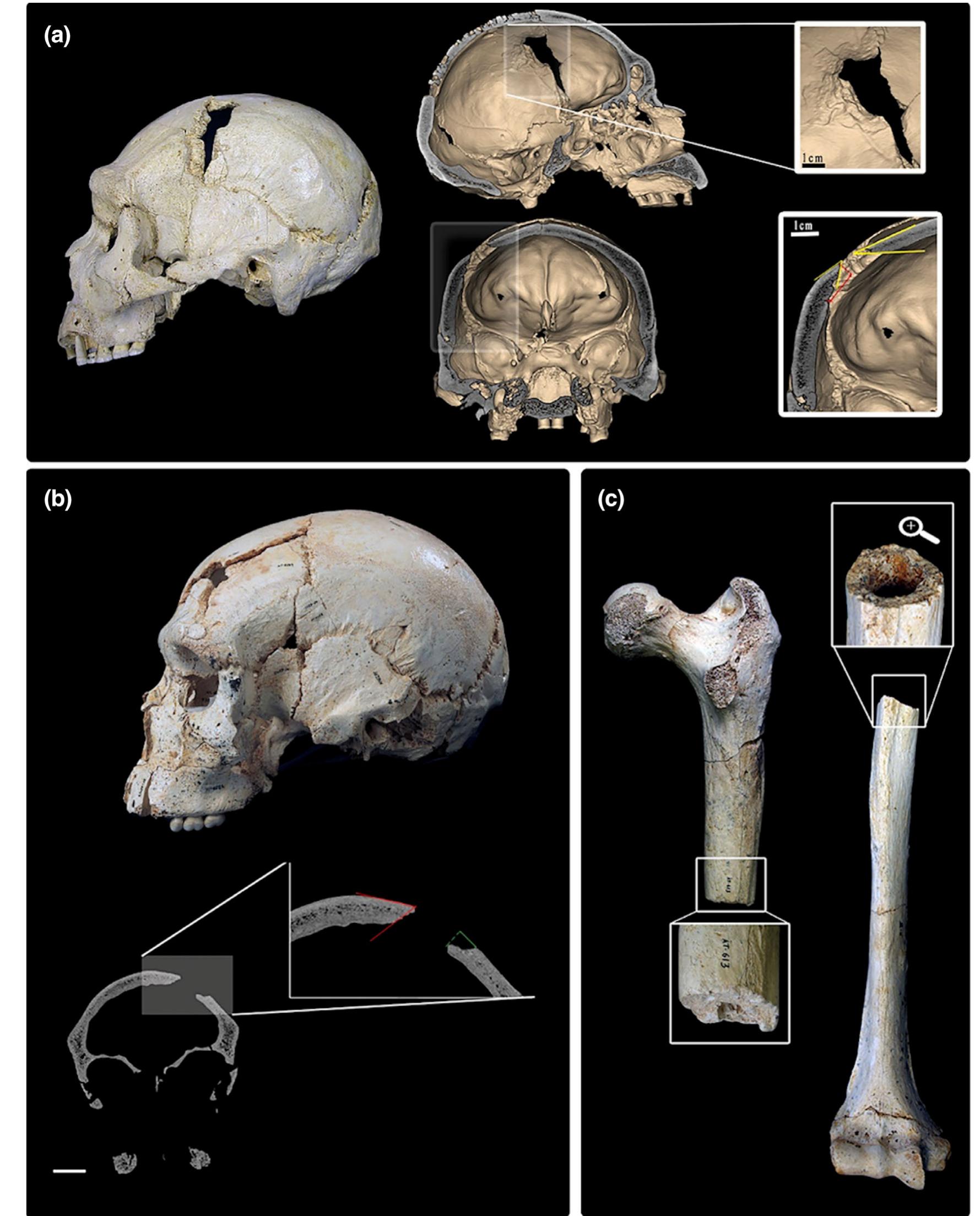 Postmortem Trauma Figure 4 - from Issues of theory and method in the analysis