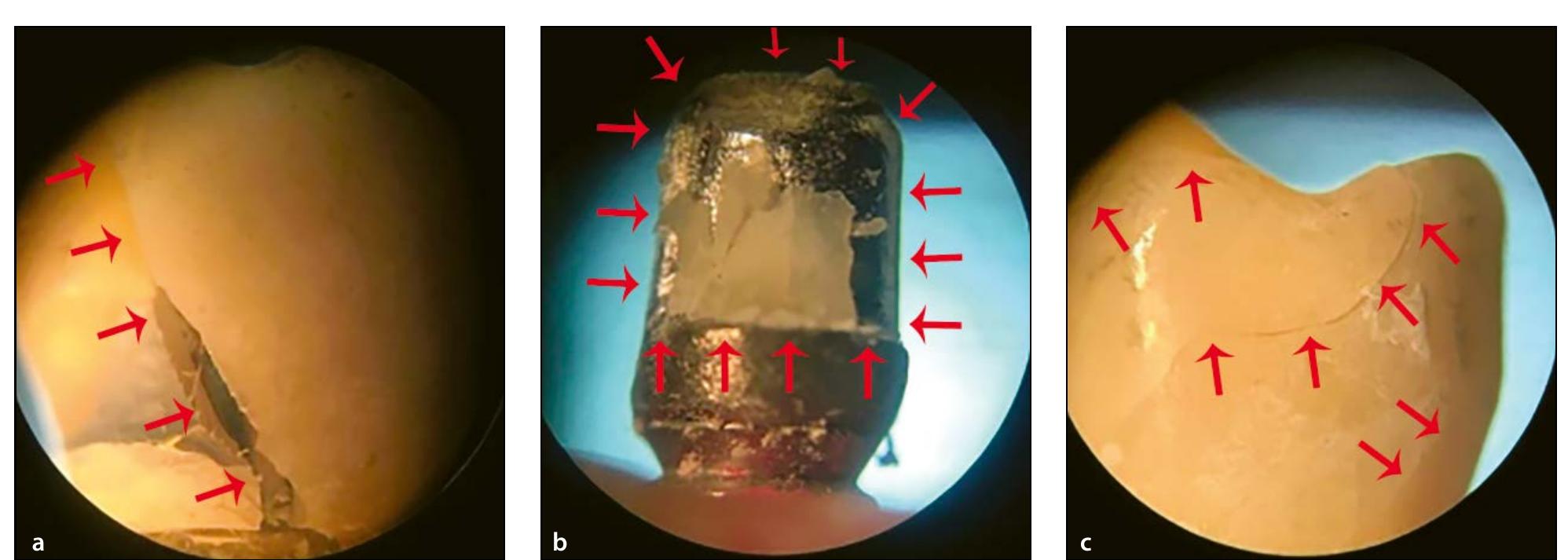 (PDF) Comparison of Fracture Resistance and Failure Mode in Digitally ...