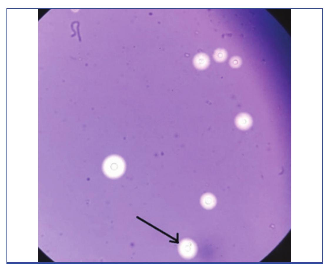 [table/fig-5]: comparison of wet mount microscopy, staining,