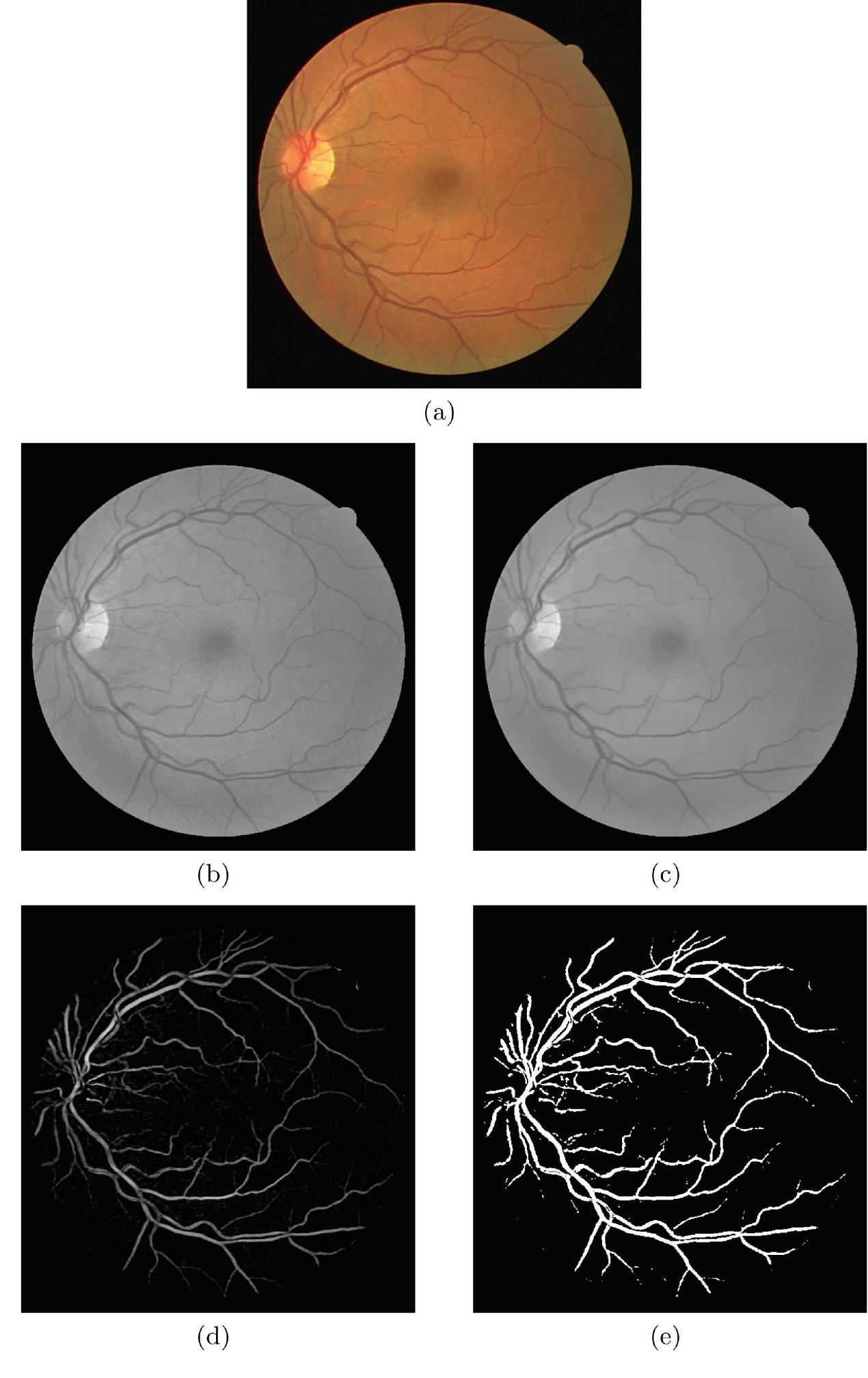 (PDF) Retinal Vessel Segmentation Through Denoising and Mathematical ...