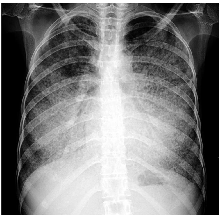Chest x-ray posteroanterior view showing showed bilateral,