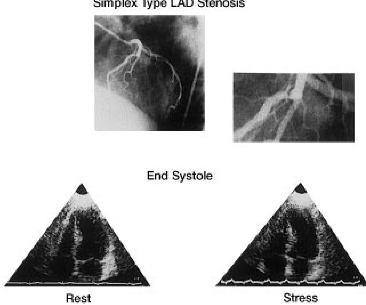 Bar graph showing caliper coronary angiographic findings of
