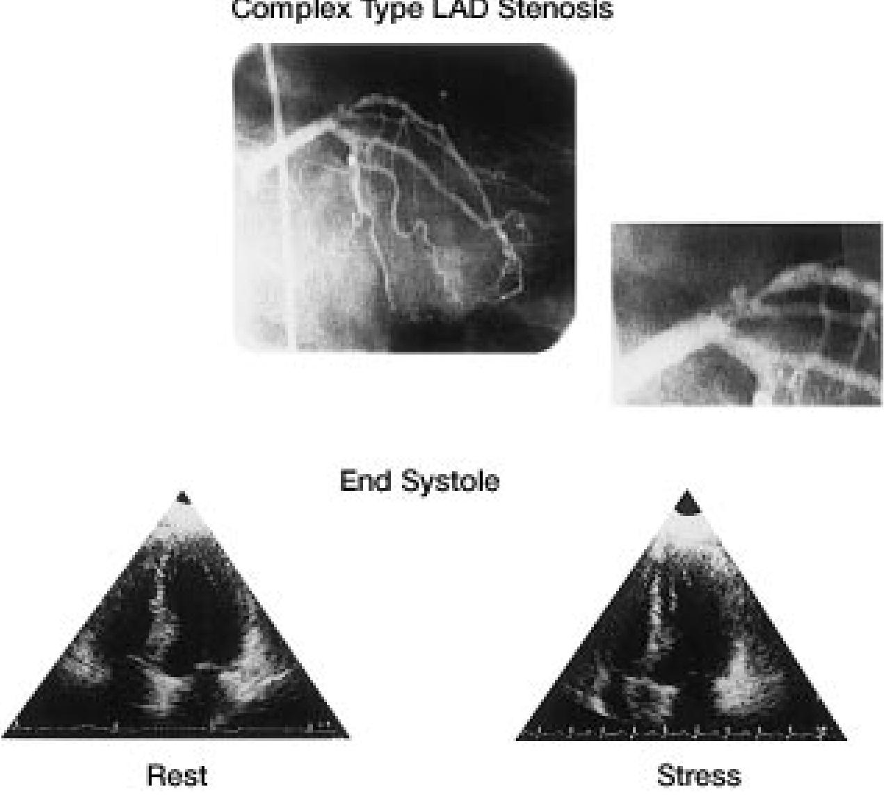 Bar graph showing caliper coronary angiographic findings of