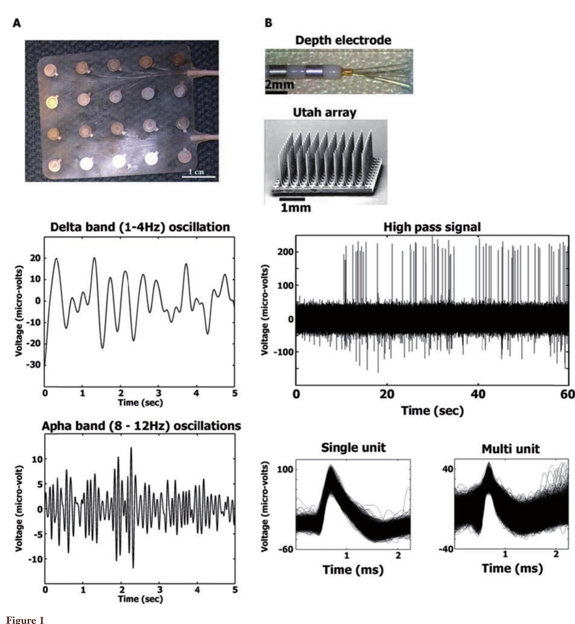 Electrode and signal types. (A) a4 x 5 grid of intracranial electrodes for recording the iEEG signal (top). Filtering the recorded signal to different frequency bands (e.g., Delta, middle panel; Alpha, bottom panel) allows examining power changes across time and cognitive tasks. (B) Depth electrodes penetrate the brain parenchyma and allow targeting of deep brain structures. Contacts along the shaft allow recording of the iEEG signal while the microwires at the tip allow recording of high-frequency activity (siddle panel) of single or very few neurons (bottom panels). The Utah array isa 10 x 10 matrix of electrodes that allow recording unit activity from superficial cortical regions (reproduced with permission from Hochberg et al. (2006). 