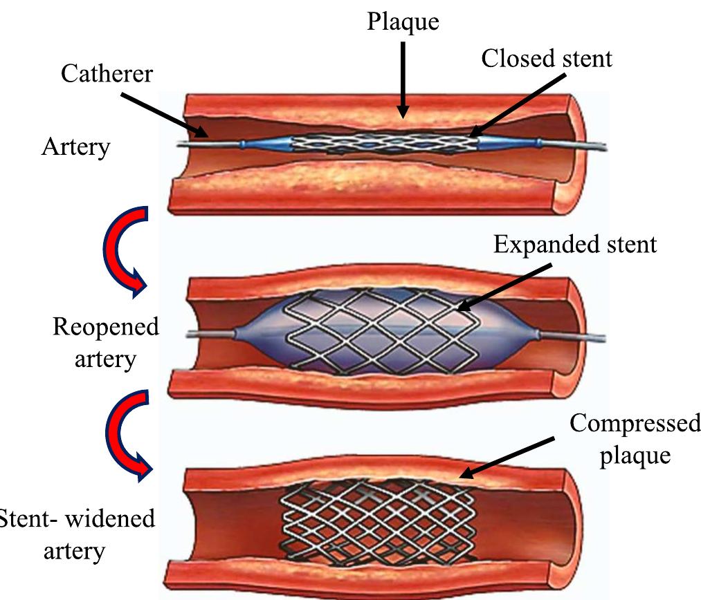 schematic-illustration-of-the-braiding-process-of-stents