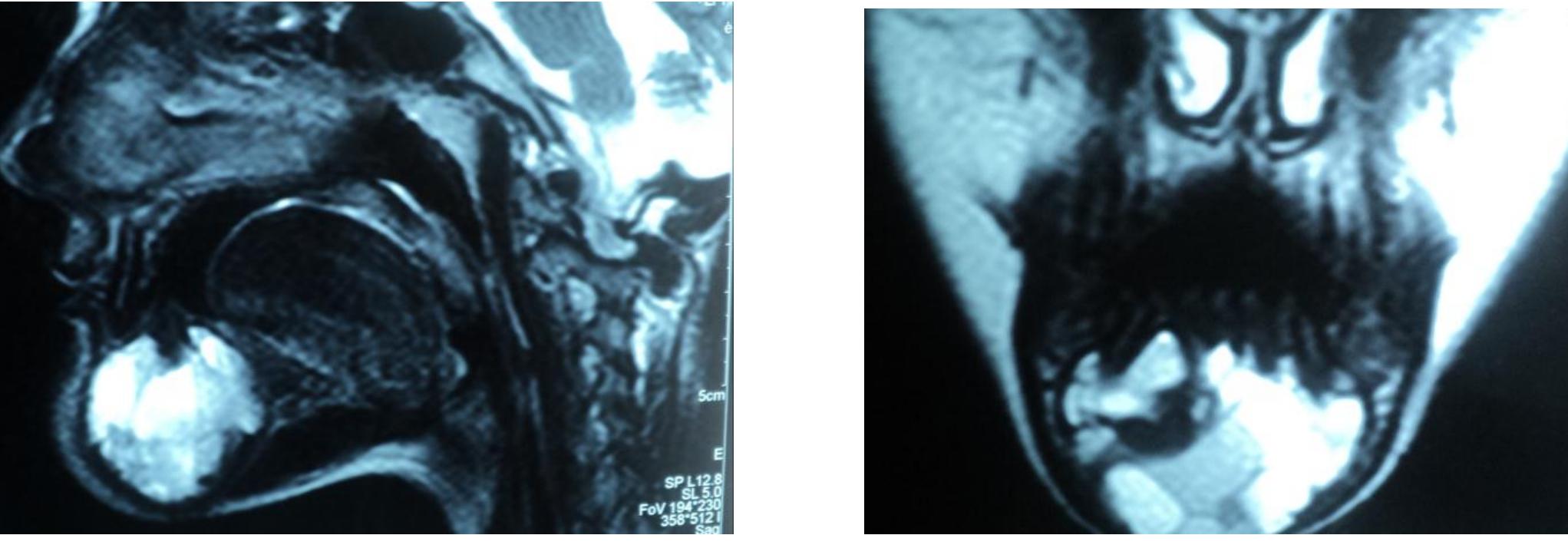 Mri Opacity - 14,15 mri in sagittal section showing fluid filled