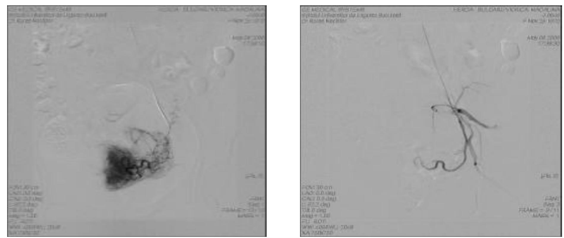 catheter was used and placed into the uterine artery under x-ray fluoroscopy guidance in order to select the uterine vessels for embolization. An angiogram with contrast was performed to confirm placement of the catheter. Afterwards an embolizing agent with rapid resorption (complete reperfusion within a few days) was released.  Figure 4 — Left tubal pregnancy — ovarian and uterine artery embolization (intraprocedural aspect) 