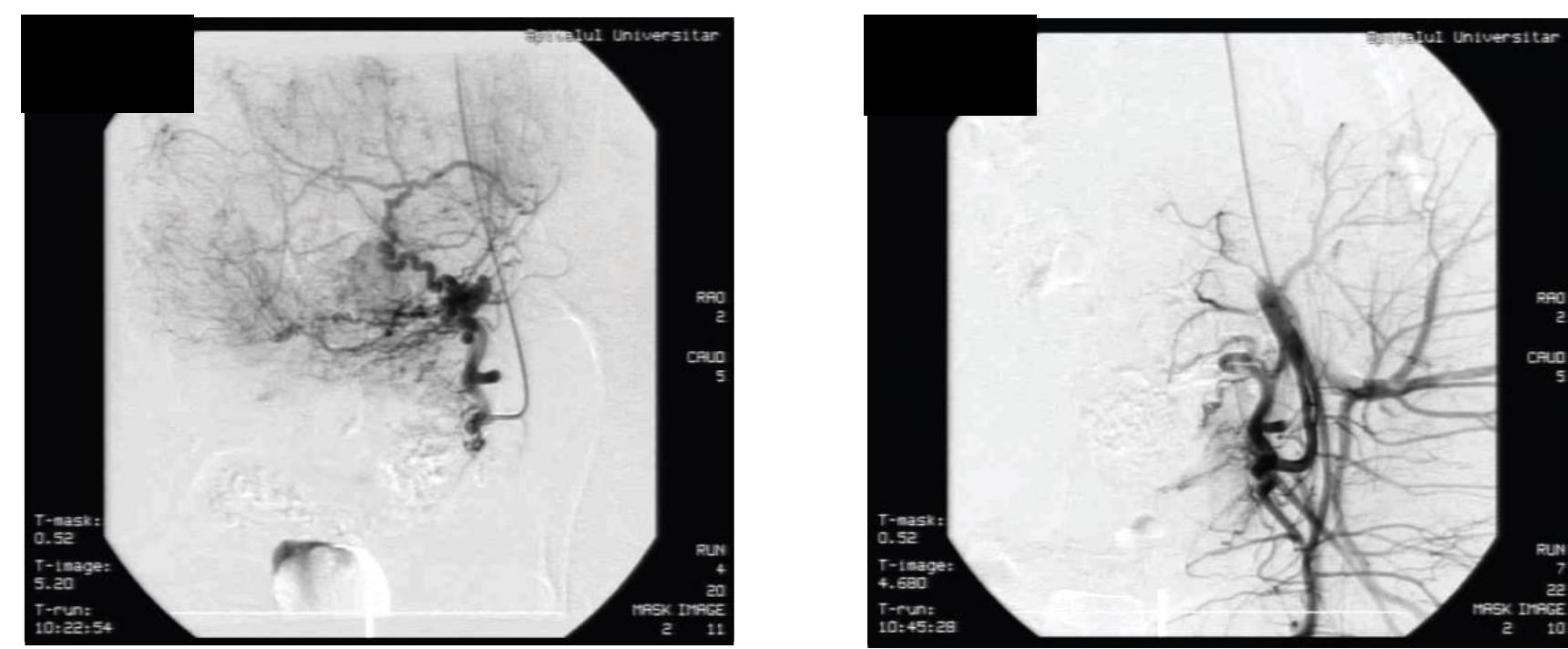 Figure 1. — Uterine artery embolization of a voluminous leiomyoma (intra-procedural aspect)  Uterine artery embolization implies the injection through a catheter placed in the brachial artery or femoral artery of small particles aimed to obstruct the vessels that supply the uterine leiomyoma.!° The procedure was performed under local anesthesia in the Invasive Radiology Department and it usually took less than one hour.  ymiting. Lhe cause of pain 1s considered to be ischemia OF DlOOd vessels and fbroid tissue. Management of pain and other symptoms required the administration of anti- flammatory drugs, analgesics and opioids given intravenously. Patients also required \tiemetic medication in the first 6 hours as vomiting occurred and as pain became more tense. The best response was obtained in patients who used a patient controlled analgesia imp (PCA) with fentanyl associated with anti-inflammatory drugs taken intravenously or ally. Usually the pain decreased gradually after 24-48 hours. Persisting pain was the main ason for prolonging hospitalization. During hospitalization, patients had no restriction in oving, no intestinal or urinary tract problems and, of course, no incisions. Protection against erine infection was made using antibiotics such as ampicillin and gentamicin or phalosporin and metronidazole. More than 80 % of patients were released from hospital ter 1-2 days after the intervention. 