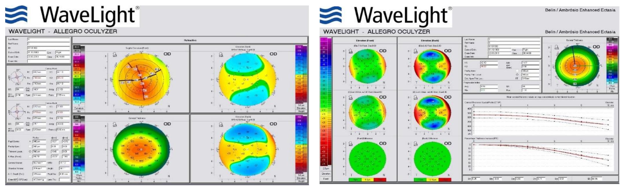Fig 1.Right eye topographies (normal appearance)  TEM PAM MAL BM MSM OM Se eee Se OMAN PS eee PVM SNE MR SE MA Be MANES OMS  stablish a therapeutic solution for diopter removal.  ‘ollowing comprehensive eye examination she was diagnosed with compound myopic stigmatism (RE: -7.5 Dsf x - cyl 3.5 “5°, LE - 11 Dsf x - 3.5 cyl “170 °). The best correctec isual acuity was 0.8 in the case of both eyes. Intraocular pressure was 15 mmHg in bott yes. The slit lamp examination of the anterior pole and of the fundus has not detected any athological change, the appearance being within age and refraction error. Local and genera linical examination did not reveal any pathology that would be relatively counterindicatec significant cataracts, patients with obsessive personality, diabetus, autoimmune diseases etc. r absolute (keratoconus, herpes virus infection of the cornea, corneal dystrophy deep rossly amblyopic eye, corneal melt, unstable refraction) a refractive surgery procedure. (7) orneal topographies were normal and pachimetry values of the two eyes were 542 micron: or the right eye and 540 microns for the left eye.  Residual stromal thickness after removal of the right eye refraction (-7,5 Dsf x - 3,5 cyl “5°), calculated using the firmware excimer laser was 297 microns, which led us to recommend the Femto LASIK technique in this case. The flap was created by using the FS200 femtosecond laser with a diameter of 9 mm and a thickness of 120 microns. At three months after surgery, using an anterior pole OCT we have measured the thicknesses of the stroma and the flap which have been 298, i.e. 120 microns. 