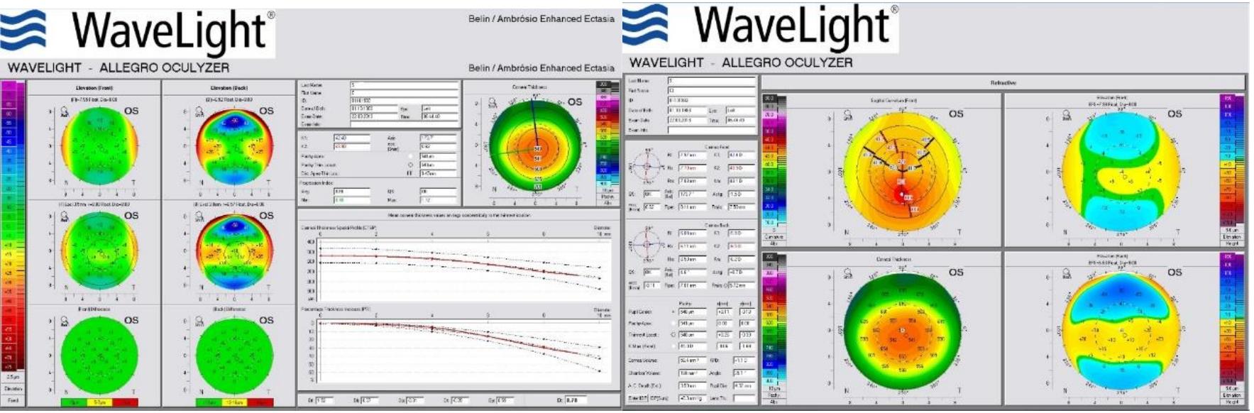 Fig 2.Left eye topographies (normal appearance) 
