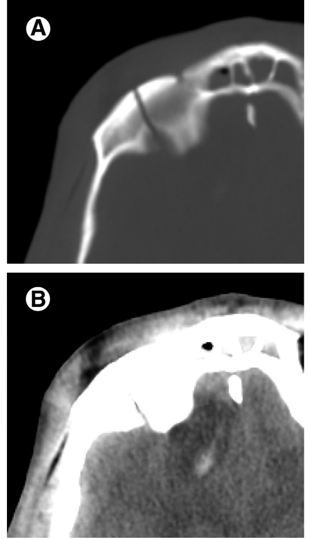 Axial ct. fracture of the orbital roof. (a) the fracture rim
