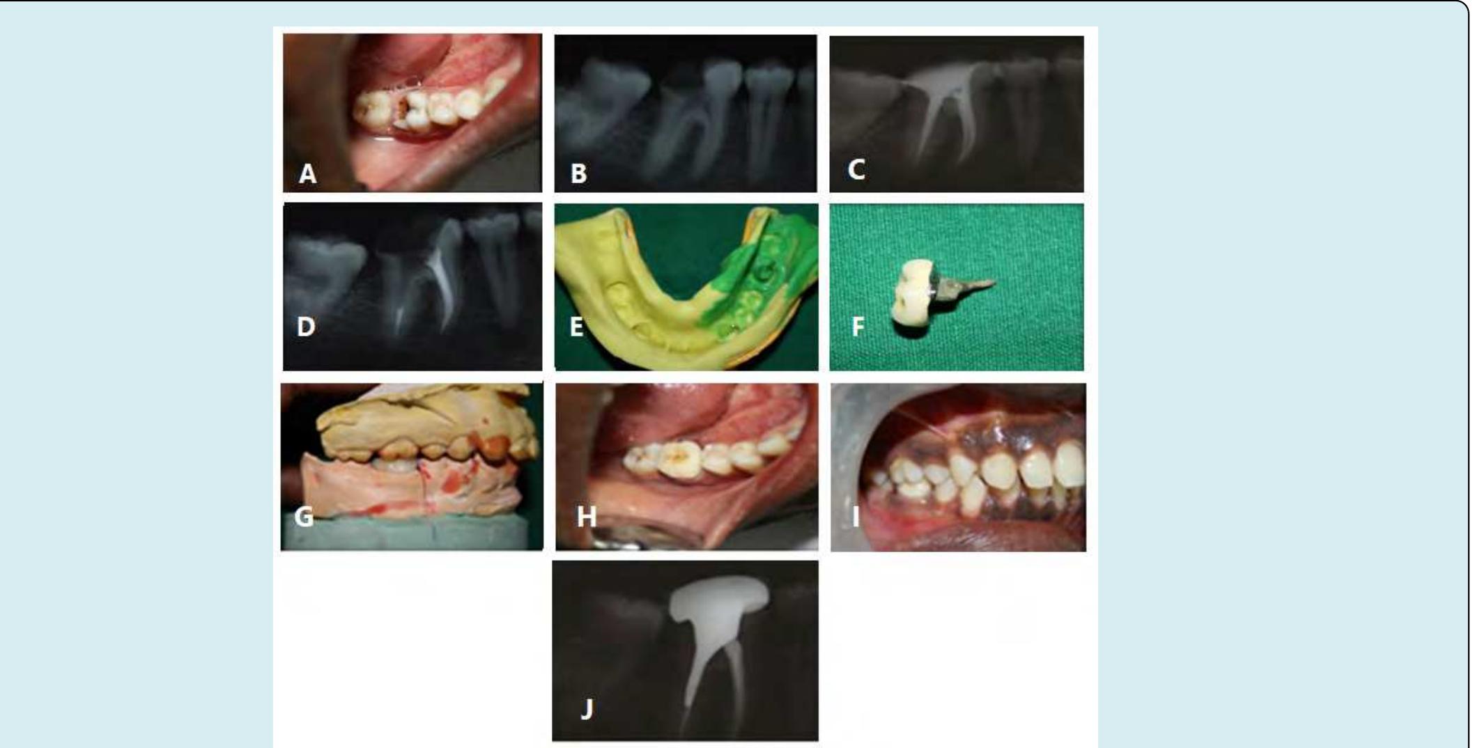 A) pre-treatment photo, b) preop-radiograph, c) x-ray after
