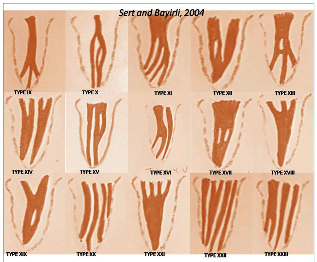 Root Configuration Figure 2 - from Classification of Root Canal Configurations: