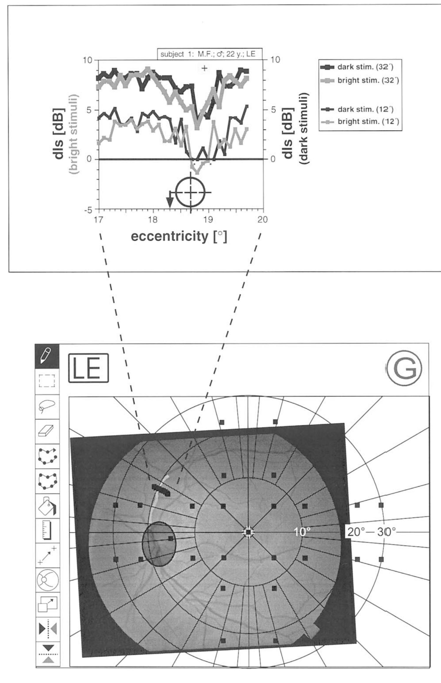 (PDF) Angioscotoma detection with fundus-oriented perimetry