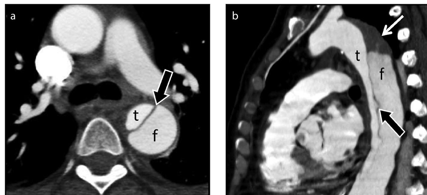 Figure 6 - from Imaging the posterior mediastinum: a
