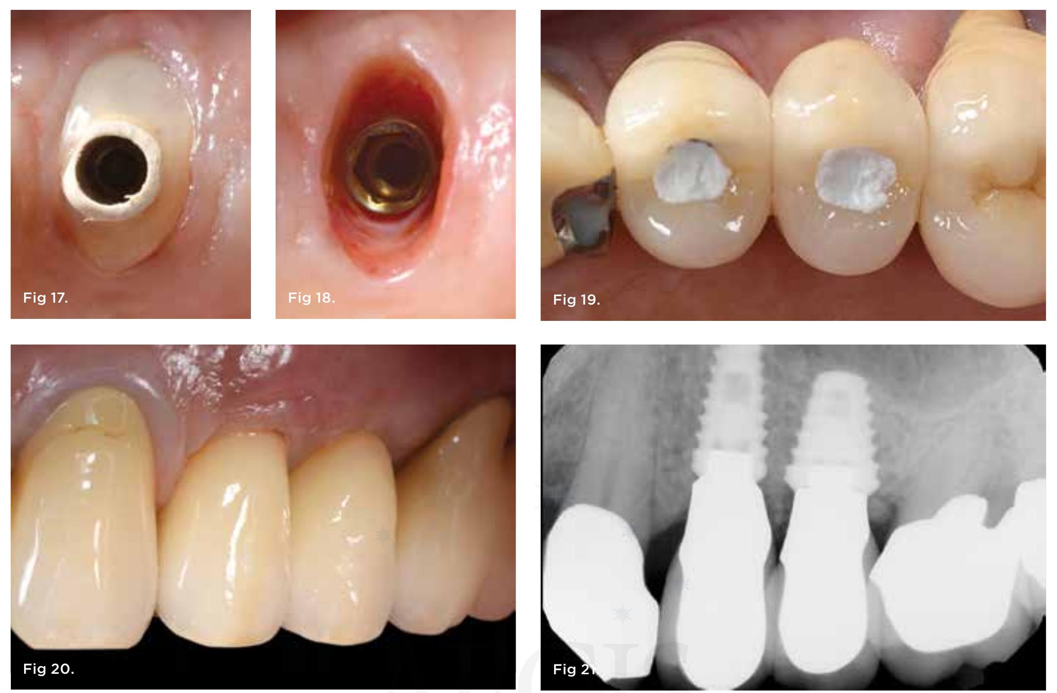 (PDF) Subclassification and Clinical Management of Extraction Sockets ...