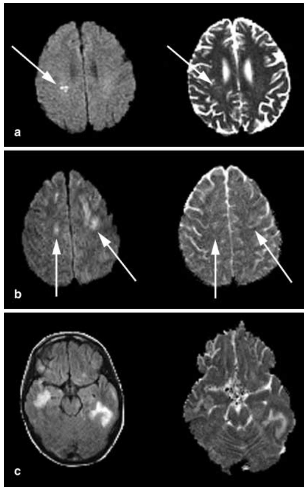(PDF) Diffusion-weighted MRI in diffuse axonal injury of the brain
