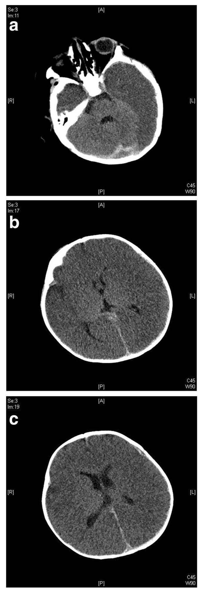 Bbb Ct A—c. bilateral bbb. initial ct scan findings in a 6-month-