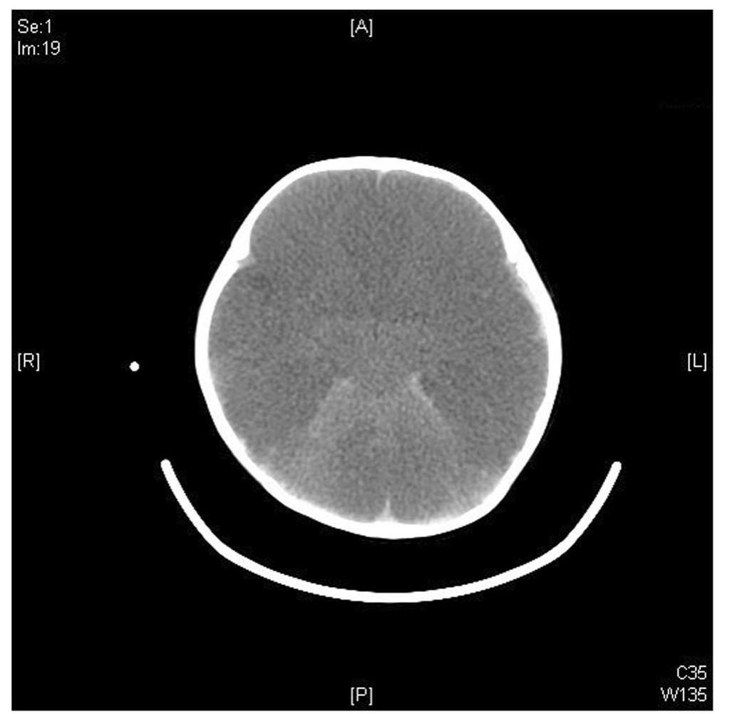 Bbb Ct A—c. bilateral bbb. initial ct scan findings in a 6-month-