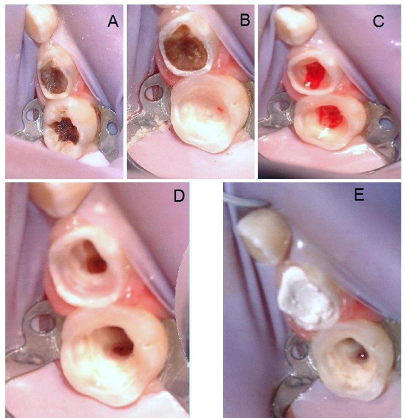 Tooth Pulp Bleeding Figure 1 - from Current concepts in vital primary pulp