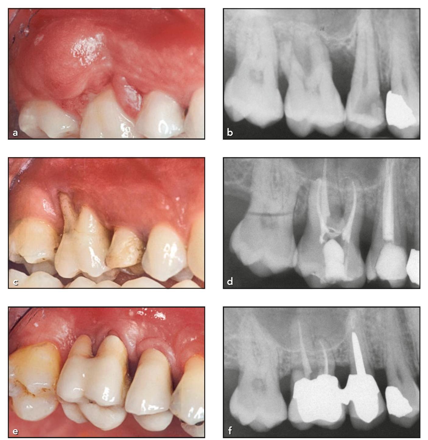 Premolar Roots Radiograph Figure 5 - from Outcomes After 25 Years of Periodontal