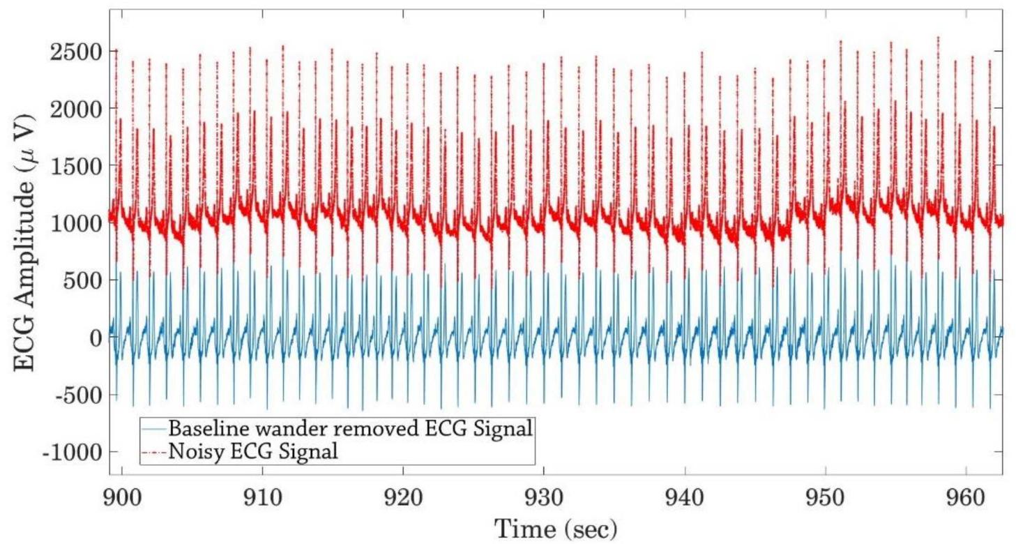 Noisy and denoised ecg signals after removing baseline