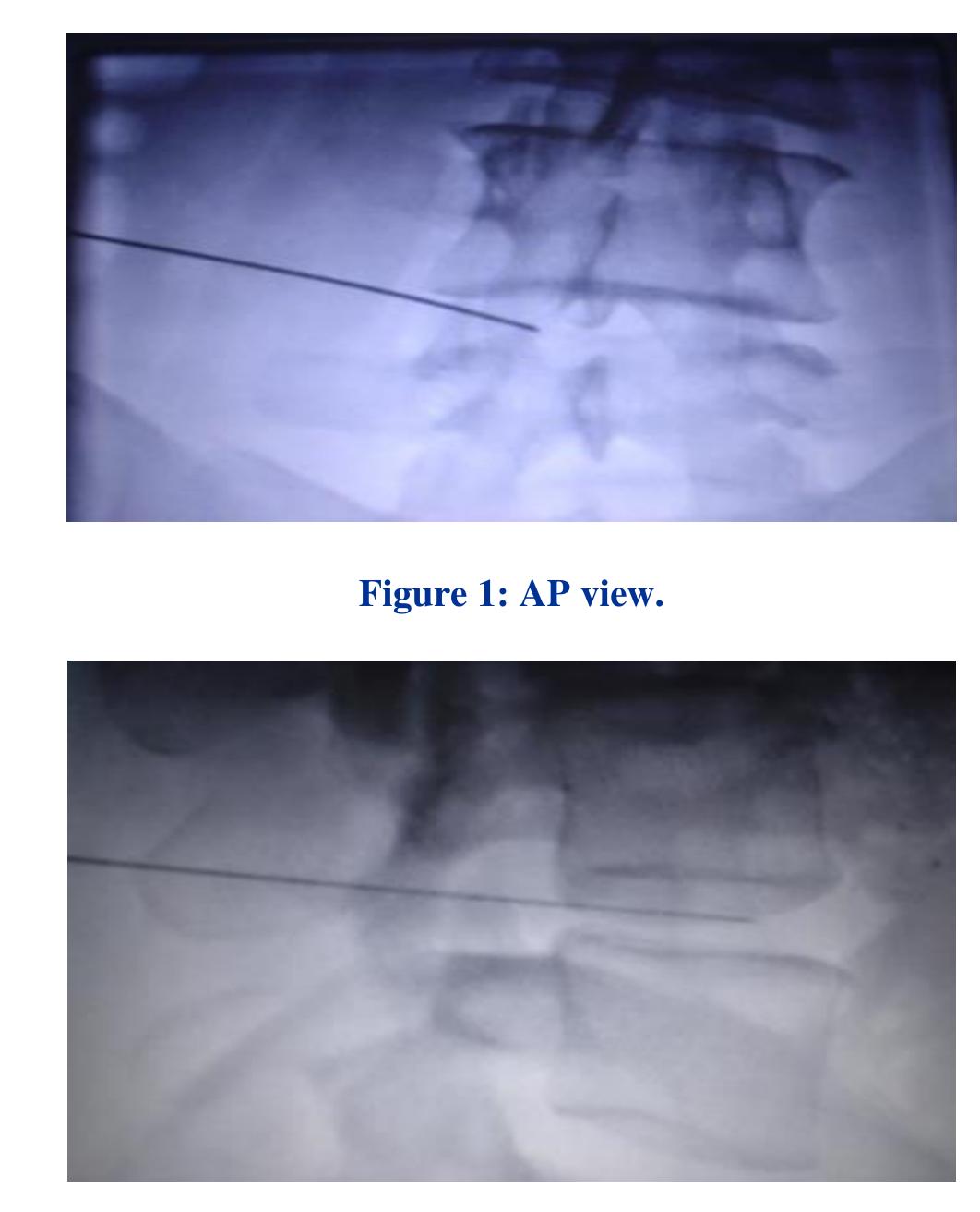 (PDF) Intradiscal injection of oxygen-ozone and intraforaminal steroid ...