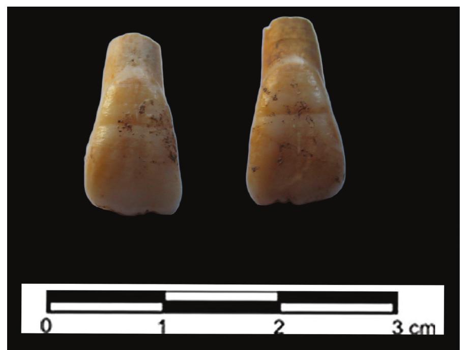 Fig. 12. Linear enamel hypoplasia on the first upper permanent incisors  Fig. 13. Cribra femoris on the neck of right femur 