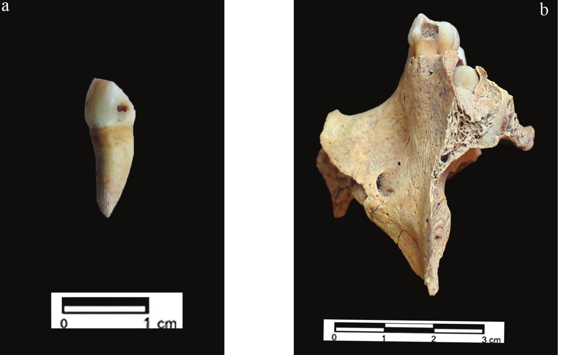 Fig. 11. Caries on tooth: (a) upper left deciduous canine, (b) upper left deciduous first molar 