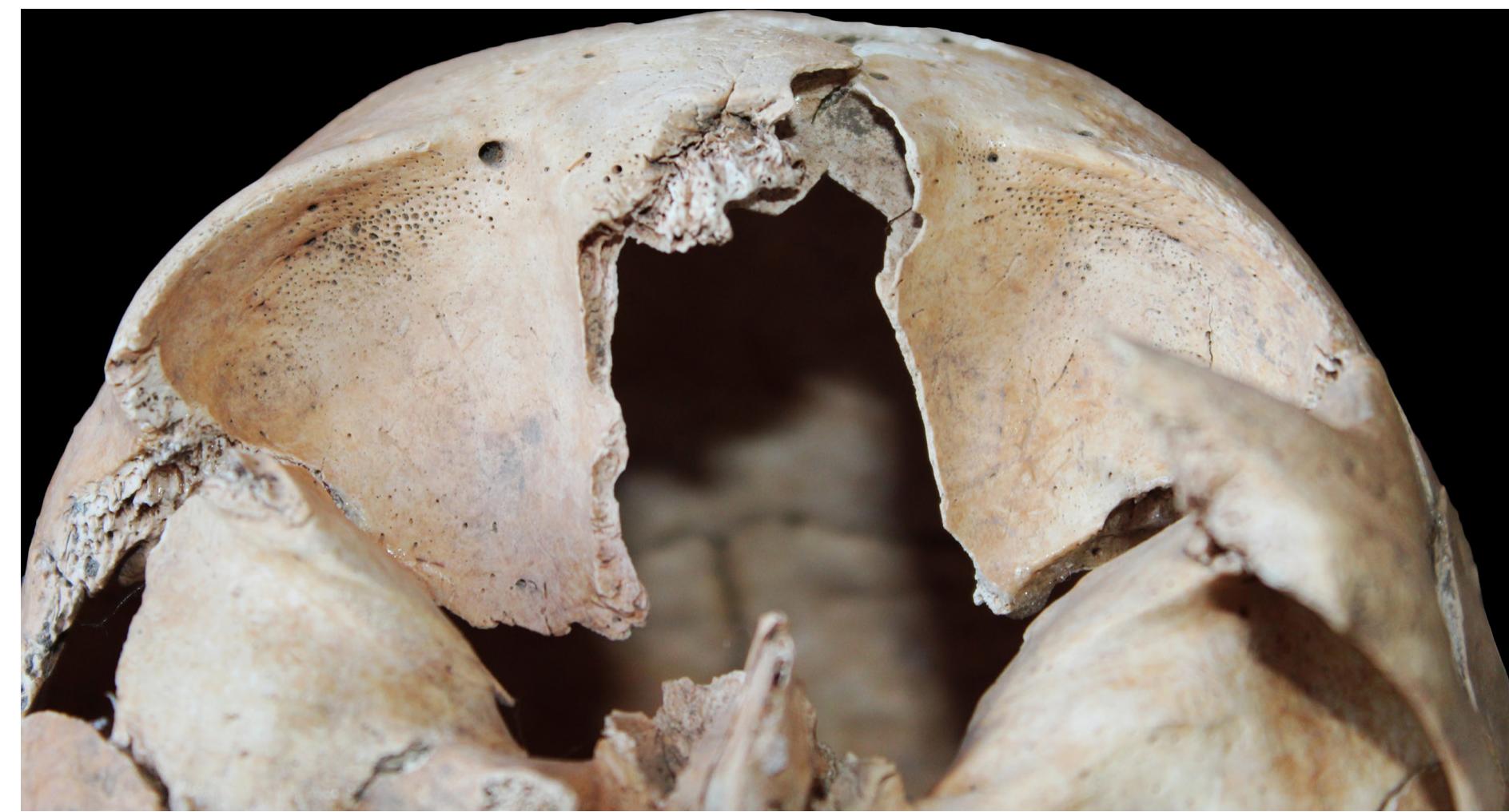 Fig. 14. Cribra orbitalia on the roofs of both orbits 