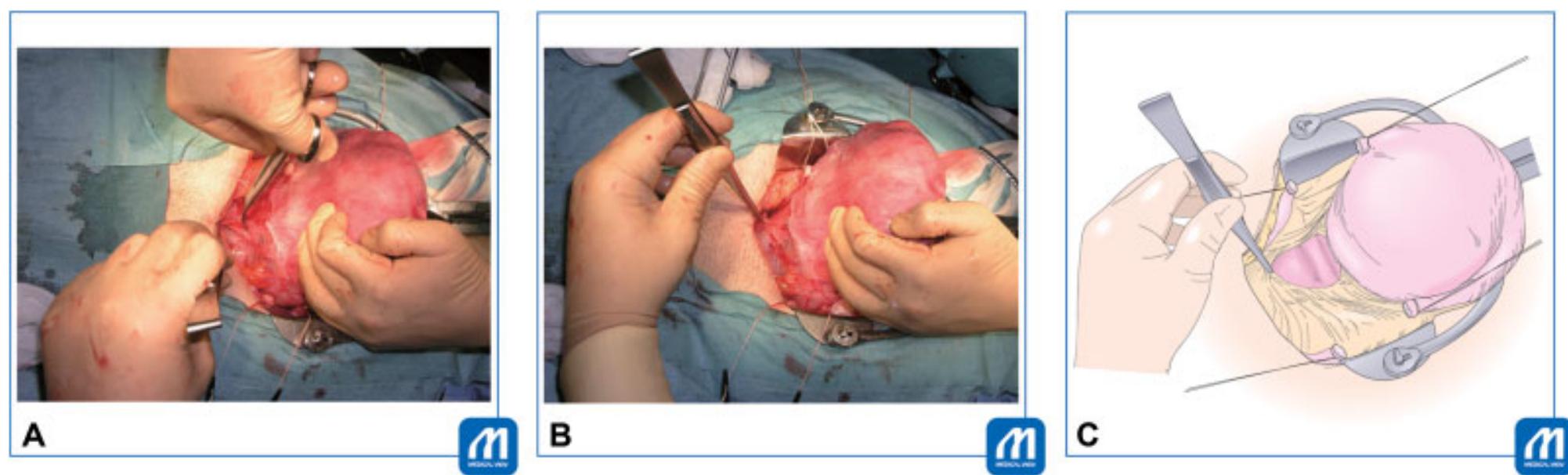 Dissection of connective tissues on cardinal ligament.