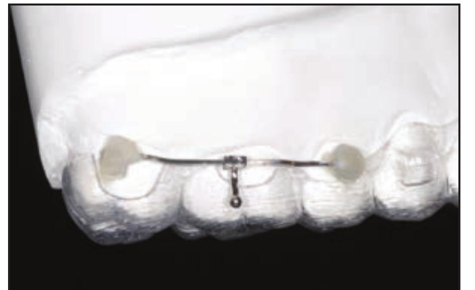 (PDF) A miniscrew-supported intrusion auxiliary for open-bite treatment ...