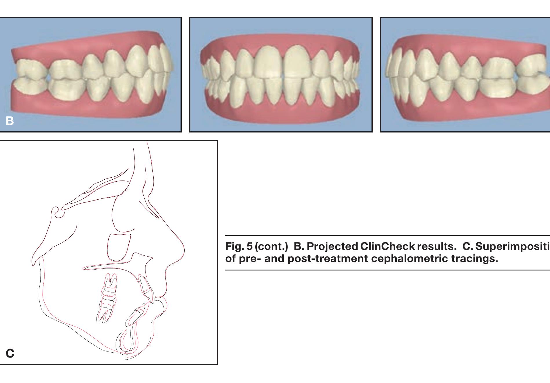 Mini Screw Invisalign (PDF) A miniscrew-supported intrusion auxiliary for open-bite treatment ...