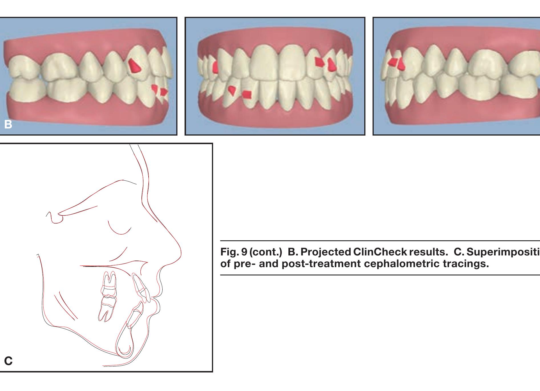 Mini Screw Invisalign (PDF) A miniscrew-supported intrusion auxiliary for open-bite treatment ...