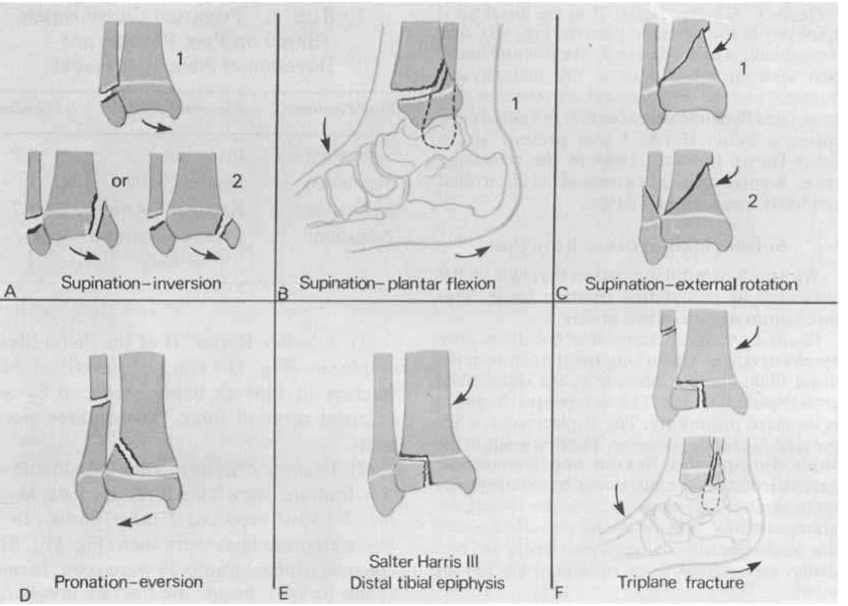 Fic. 1. (a) supination-inversion. (b) supination-plantar