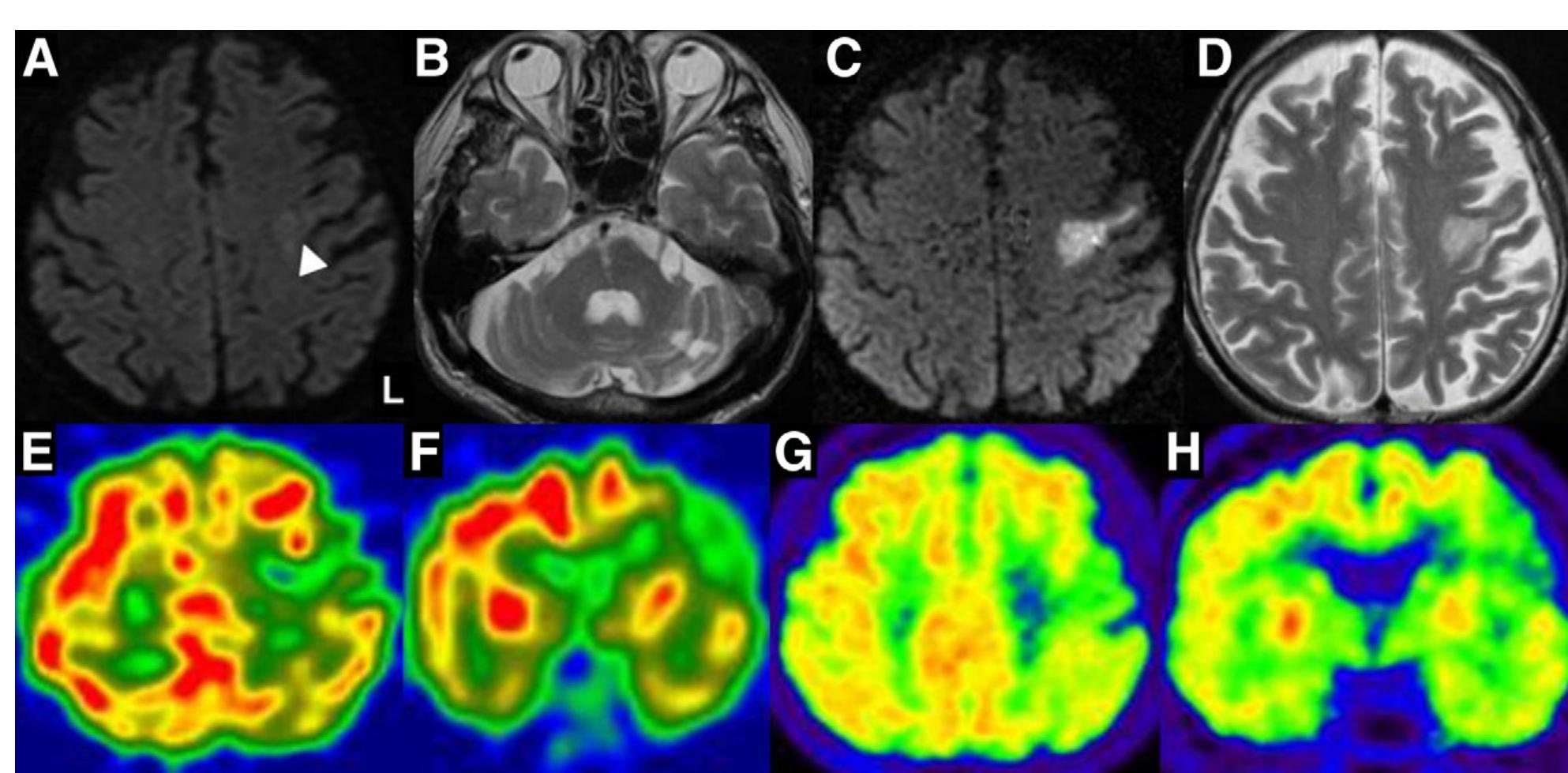 Opercular Acute Infarct (PDF) Unilateral Opercular Infarction Presenting with Foix-Chavany ...