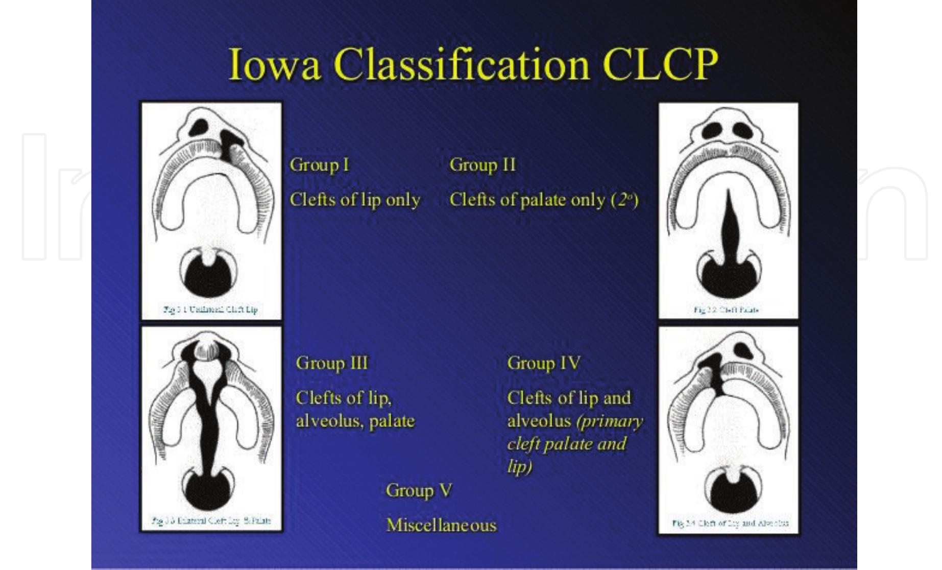 Veau Classfication Figure 1 - Cleft Lip and Palate Management from Birth to