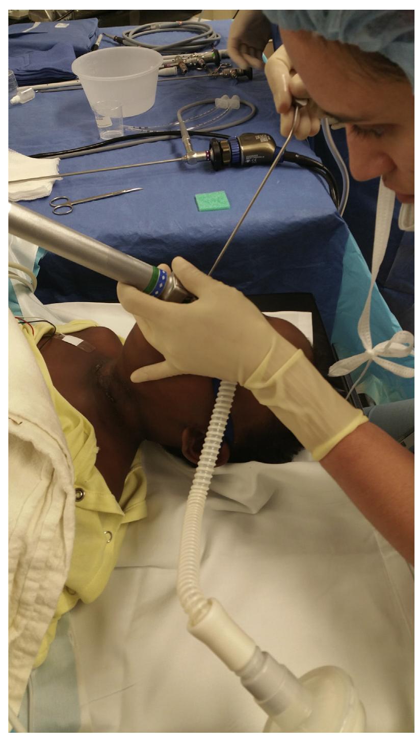 (PDF) Anesthesia in Diagnostic and Therapeutic Pediatric Bronchoscopy