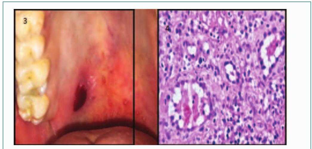 Pyogenic Granuloma Oral Cavity Histology