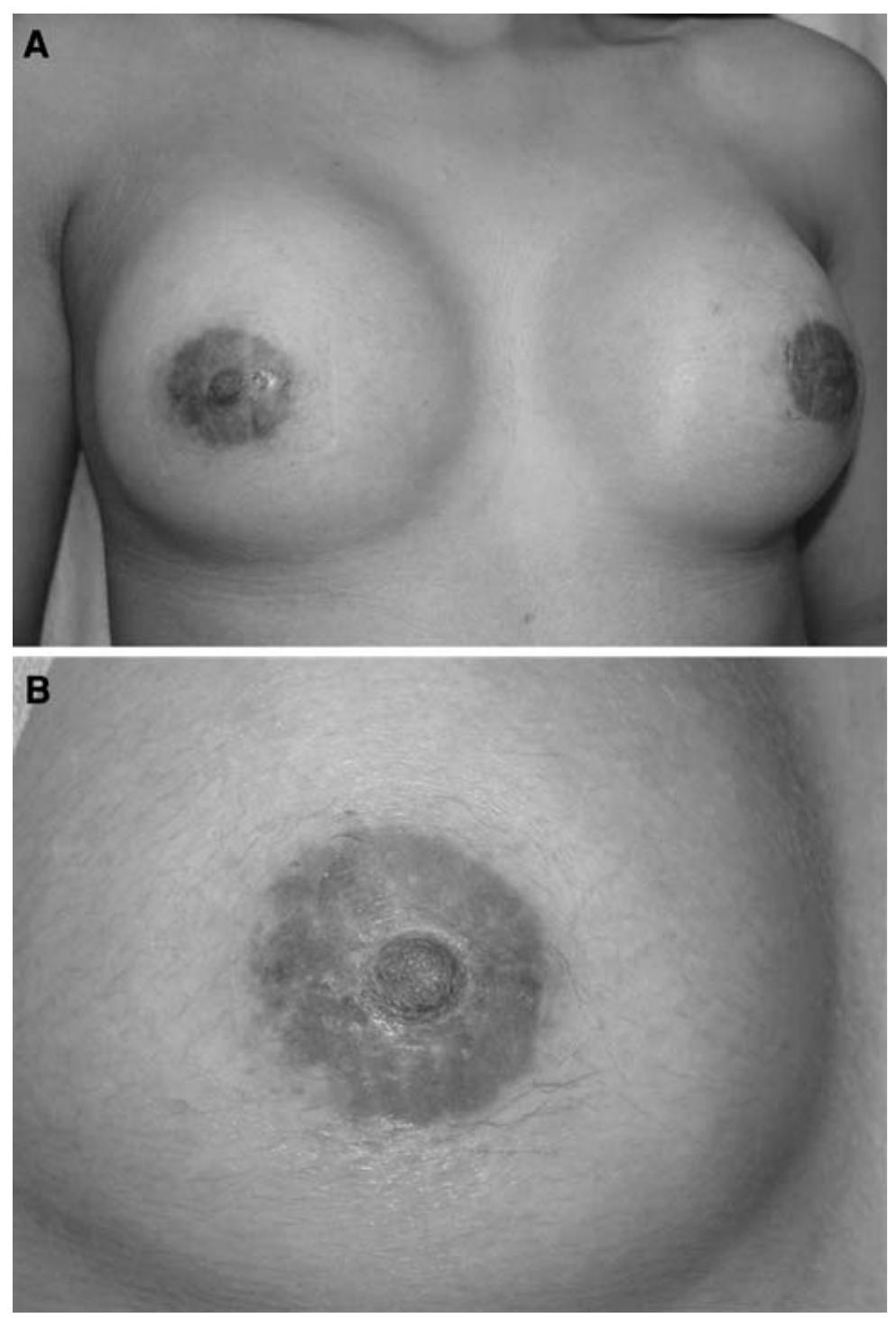 (PDF) Transareolar Incision with Geometric Broken Line for Breast ...