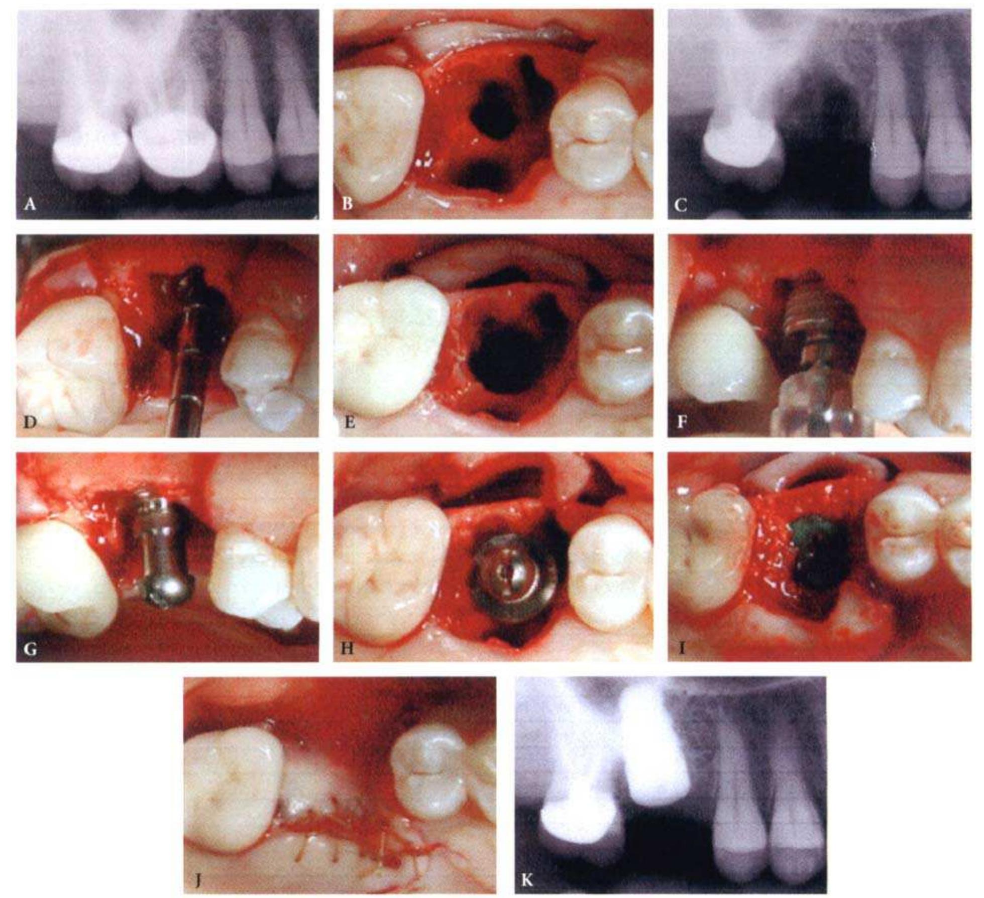 Pre Extraction Radiograph A, presurgical radiograph. b, photograph of tooth 3 shows