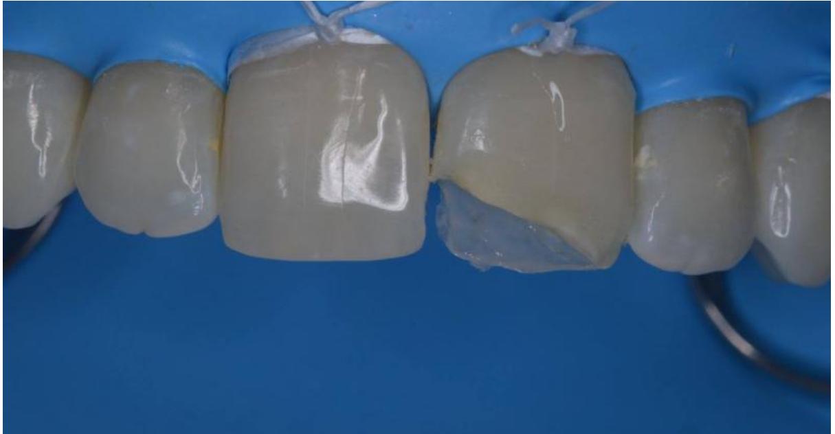 (PDF) Fractured Anterior Tooth Using Direct Composite Restoration : A ...